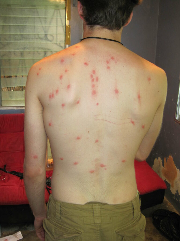 ugryzienia pluskwy domowej