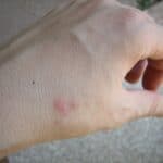 ugryzienia insektów